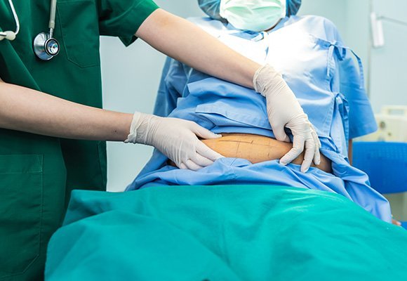 Abdominoplasty tummy tuck procedure