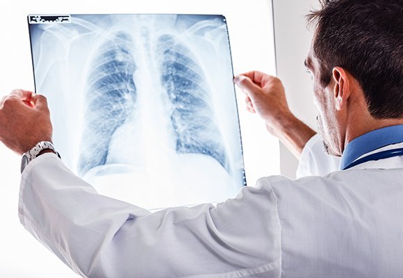 Pulmonary embolism